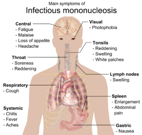 mononucleosis infectiosa of de Ziekte van Pfeiffer