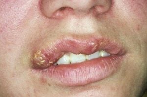 Spanningshoofdpijn en het optreden van herpes