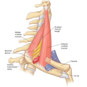 Thoracic Outlet als onderdeel van schouder-armsyndroom