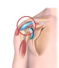 bursitis schouder
