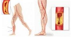 claudicatio intermittens of etalagebenen