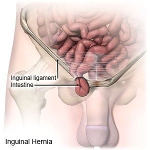 hernia inguinalis (liesbreuk)