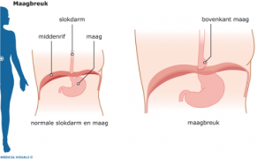 Hiatus Hernia of middenrifsbreuk