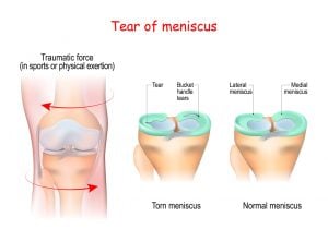 meniscus