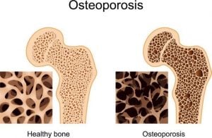 osteoporose