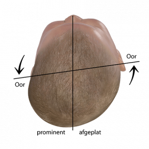 Afgeplatte schedel