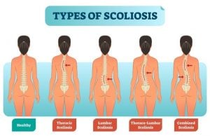 typen van scoliose