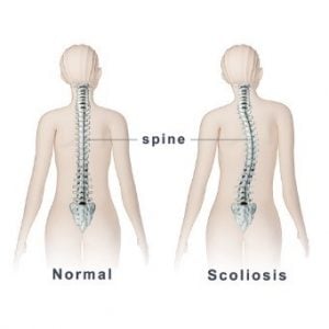 scoliose