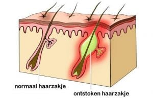 ontstoken haarzakje (steenpuist)