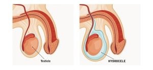 verschillende aandoeningen van de testis
