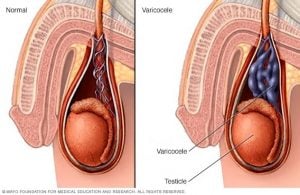 variocele van de testis