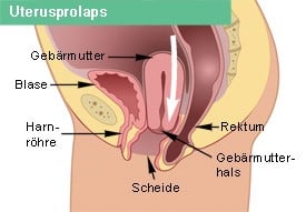 baarmoederverzakking